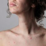 la varicela en adultos